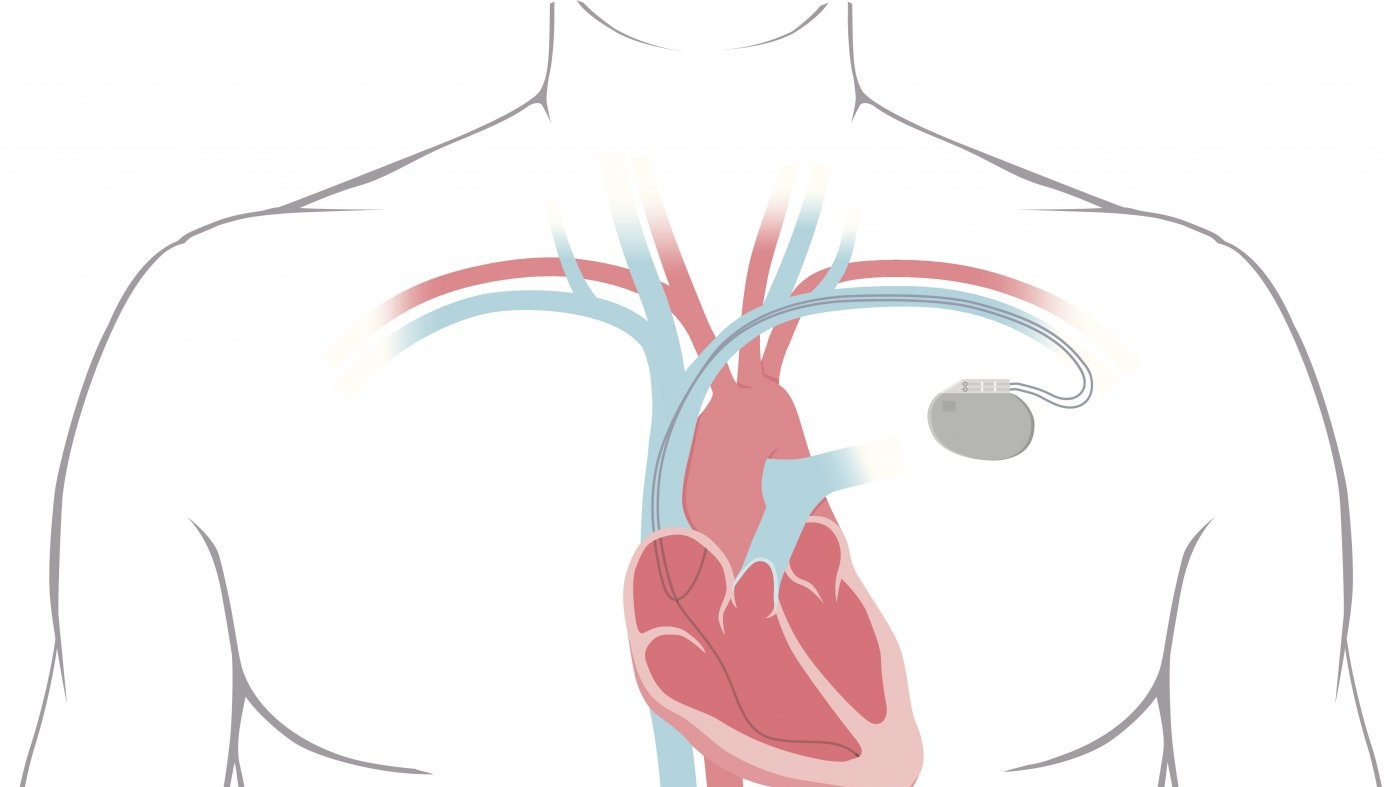 Pacemaker and Automatic Implanted Defibrillators